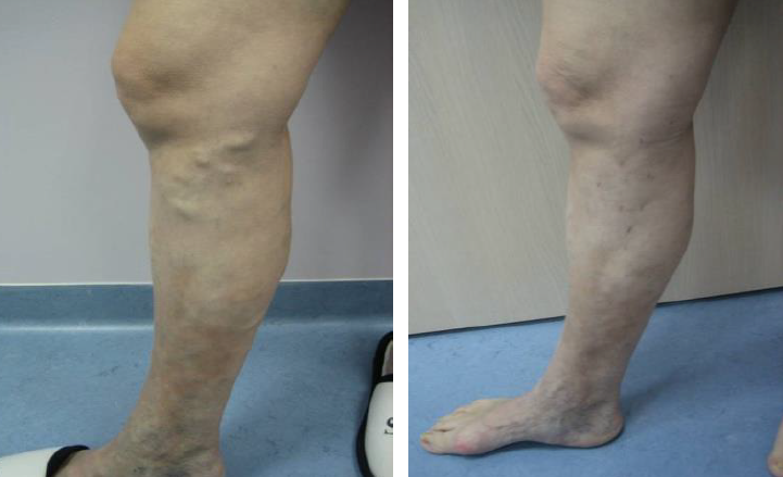 visszér lézeres kezelés ára vitebsk visszér a lábakban tünetek kezelése