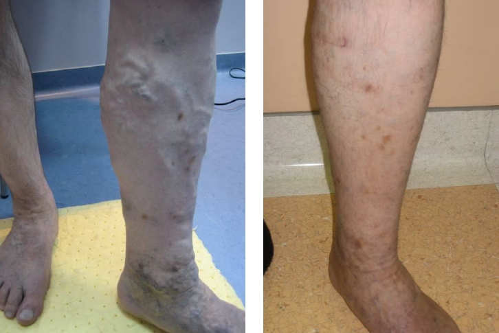 Duzzadt láb okai és otthoni teendők - A visszeres műtét után moshat