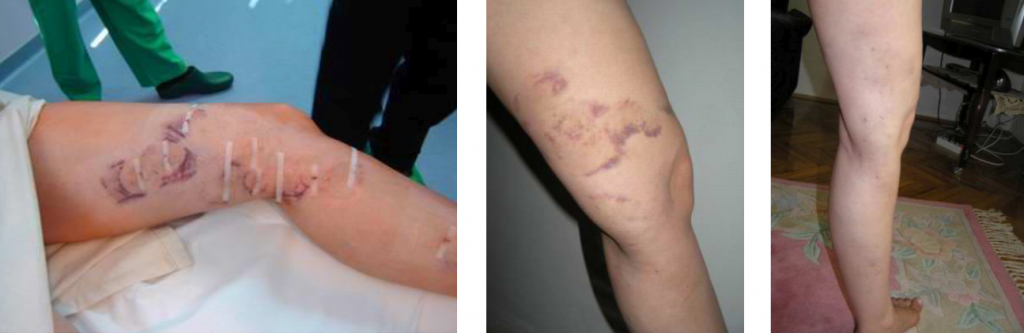 a lábak visszértágulata műtét előtt és után